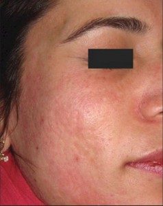 after Micropen treatment on female patient