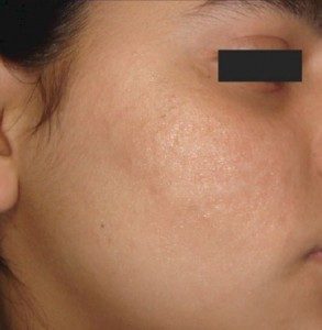 after Micropen treatment