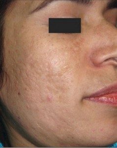 before Micropen treatment on female patient