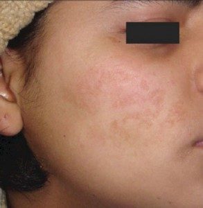 before Micropen treatment