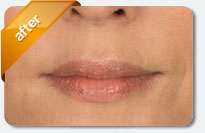 treatment for deep lines