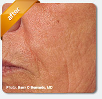 improved wrinkles and deep lines