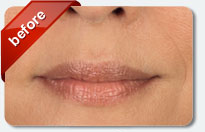 deep wrinkles and laugh lines