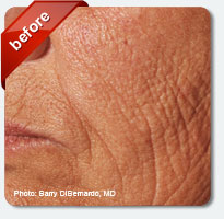 deep lines on the cheeks