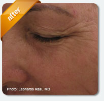 treatment of enlarged pores