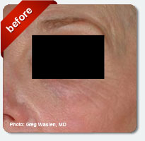 enlarged cheek pores