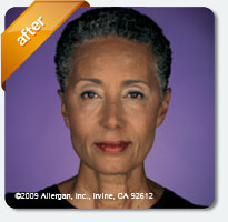 treatment of finelines