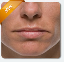 fine lines removed after treatment