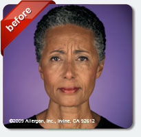 forehead wrinkles and laugh lines