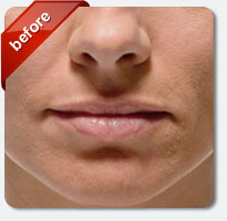 fine lines around mouth and nasolabial area