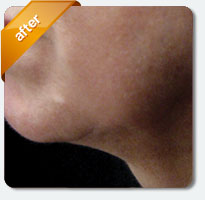 after Titan laser treatment closeup view female patient Palm Springs, CA