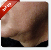 before Titan laser treatment closeup view female patient Palm Springs, CA