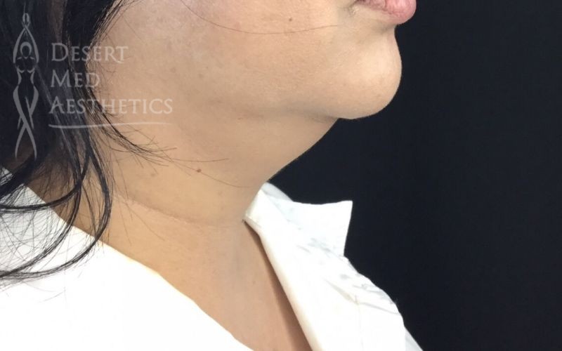 after coolsculpting to the chin