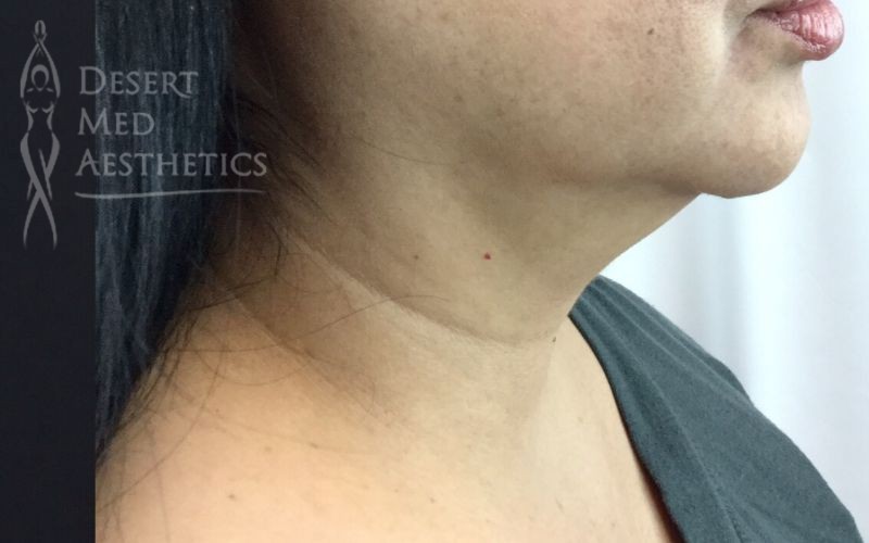 after coolsculpting lower face and chin