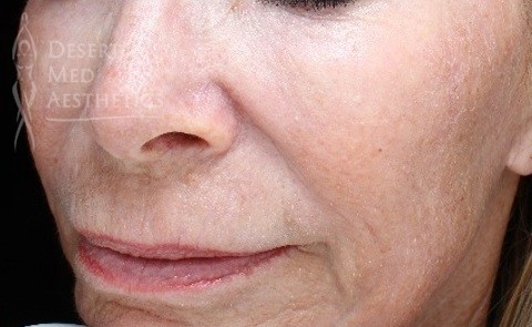 Patient results from Pearl Fusion fractional laser treatment at Desert Med Aesthetics