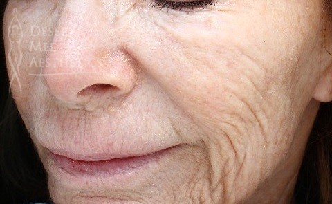Patient before fractional laser treatment in Palm Desert