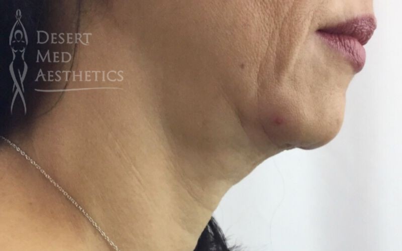 before coolsculpting on female patient's chin