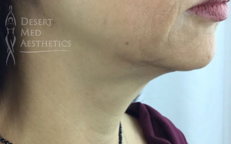 after coolsculpting on female patient's chin