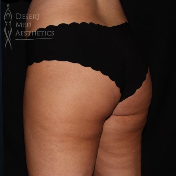 smooth buttock area with reduced banana rolls after coolsculpting
