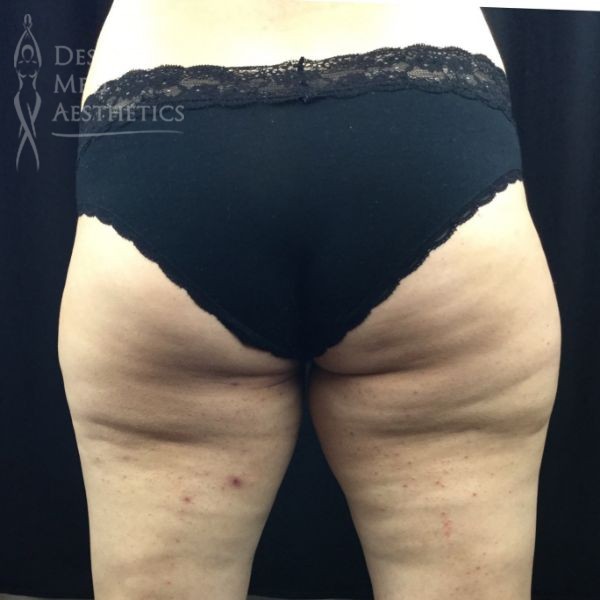 view of female patient's buttocks before coolsculpting