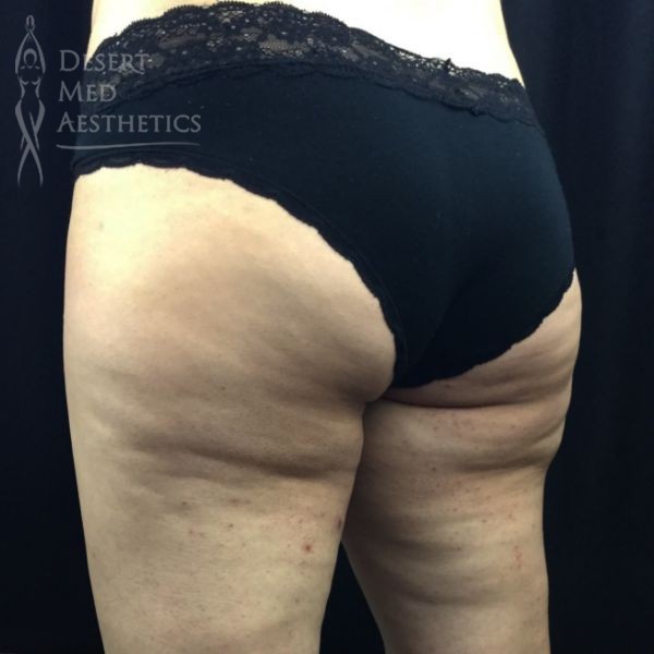 banana rolls in buttock area before treatment