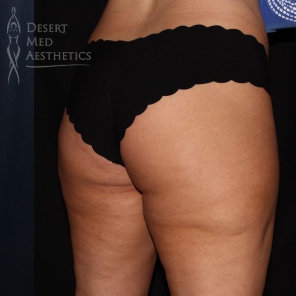 smoother underbutt area after coolsculpting
