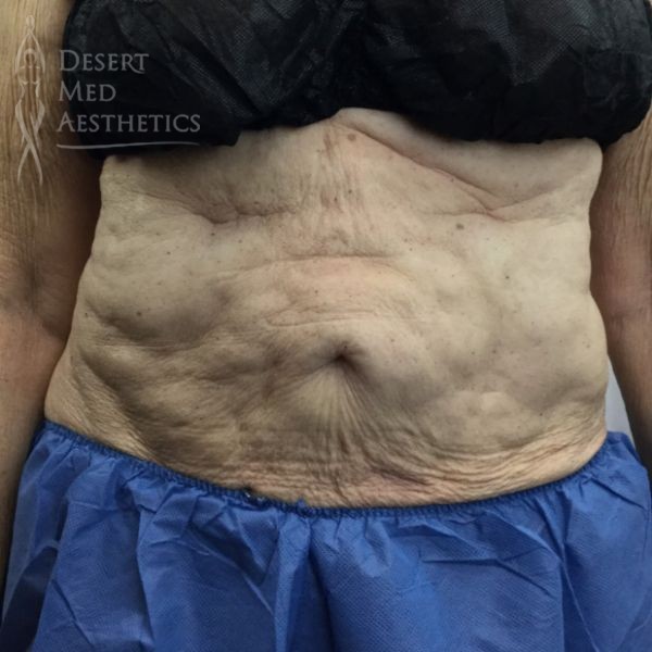 before coolsculpting on mature female patient's abdomen