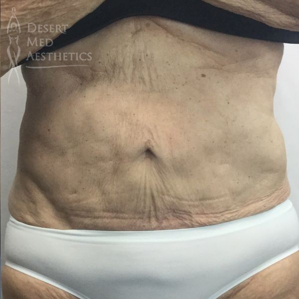 after coolsculpting on mature female patient's abdomen