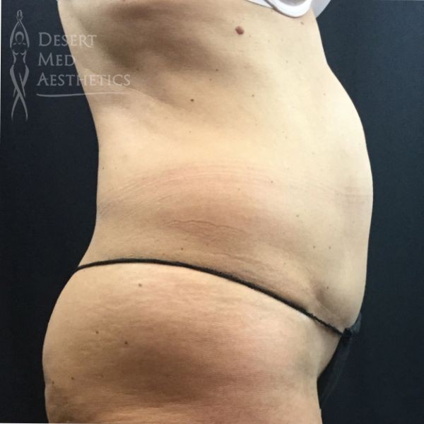 before coolsculpting on female patient's abdomen right profile view case 5