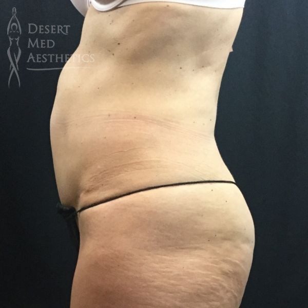 before coolsculpting on female patient's abdomen left profile view case 5