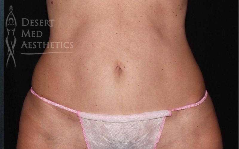 after coolsculpting on female patient's abdomen case 5