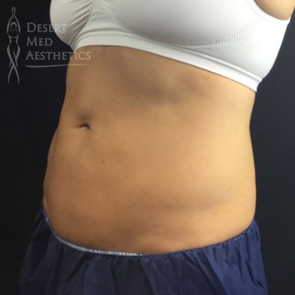 lower abdomen after coolsculpting case 4 left oblique view