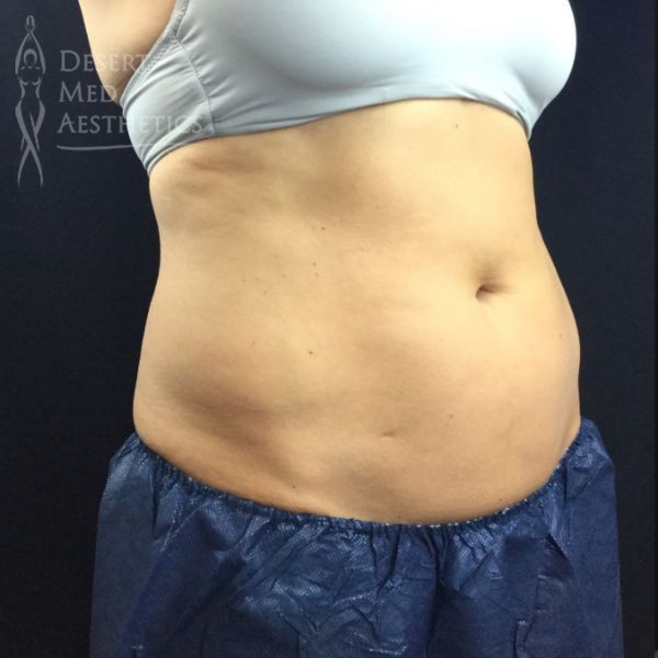 lower abdomen before coolsculpting case 4 right oblique