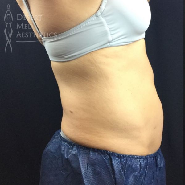 lower abdomen before coolsculpting case 4 right profile view
