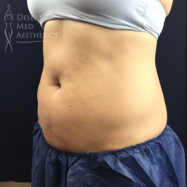 lower abdomen before coolsculpting case 4 left oblique view
