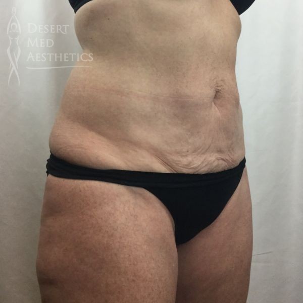 right oblique view after coolsculpting on female patient's flanks case 3