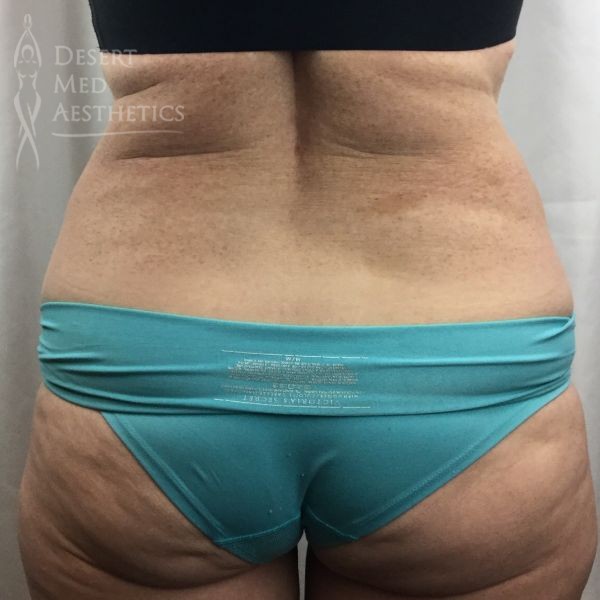 rear view of female patient's flanks after coolsculpting case 3