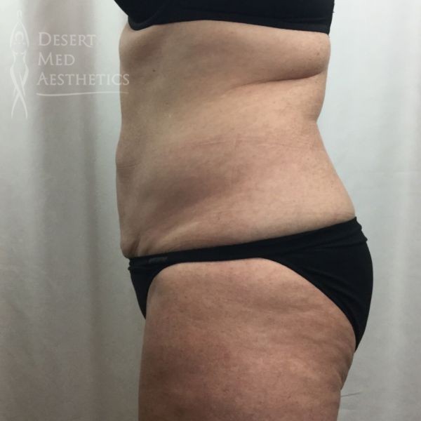 after coolsculpting on midsection left profile view patient 3