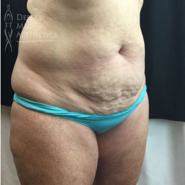 right oblique view before coolsculpting on female patient's flanks case 3