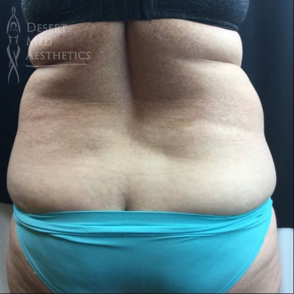 rear view of female patient's flanks before coolsculpting case 3