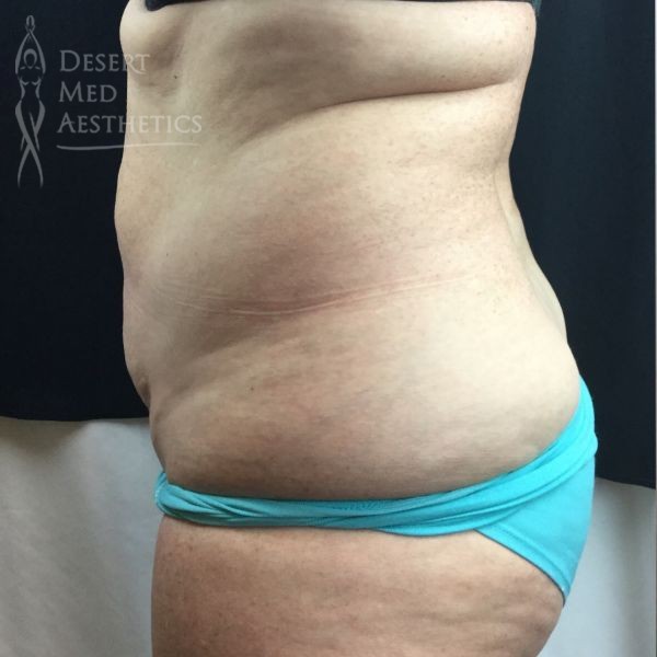 before coolsculpting on midsection left profile view patient 3