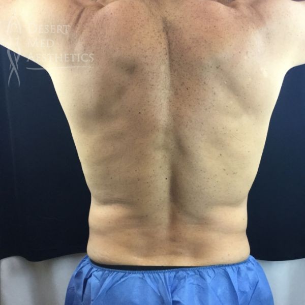 back view of male patient after coolsculpting
