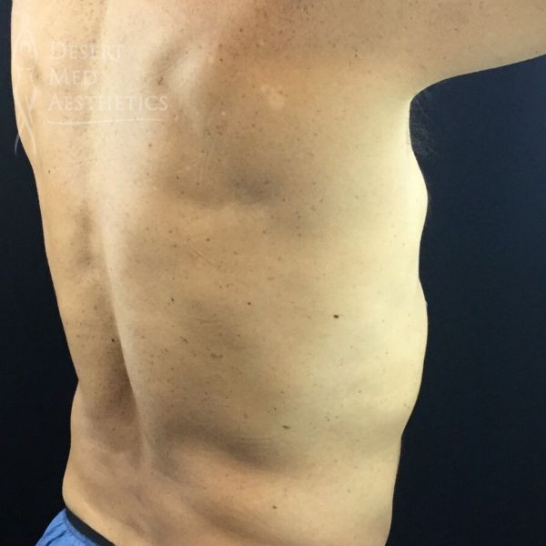 right oblique view of male patient's flanks after coolsculpting
