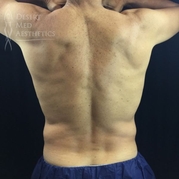 back view of male patient before coolsculpting