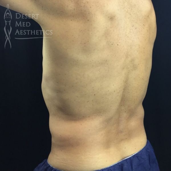 left oblique view of male patient's flanks before coolsculpting