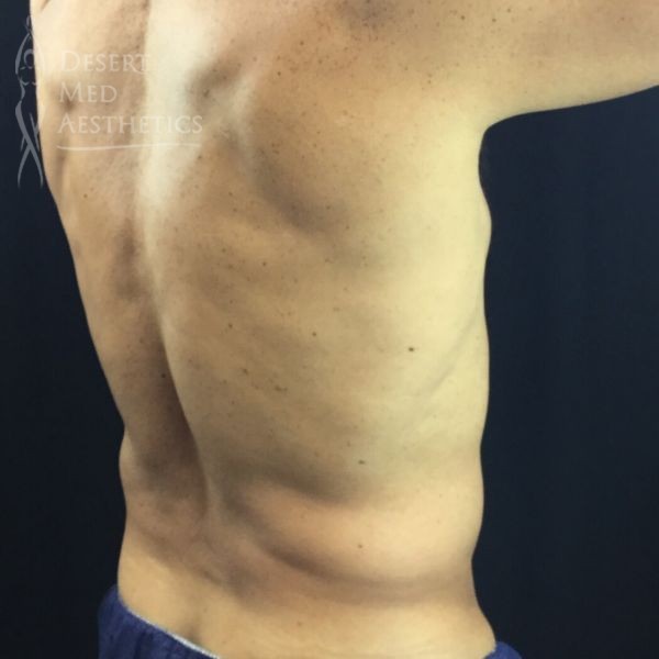right oblique view of male patient's flanks before coolsculpting