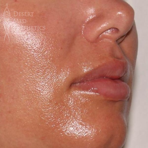 patient's lips after lip fillers