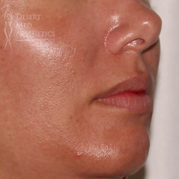 patient's lips before lip fillers