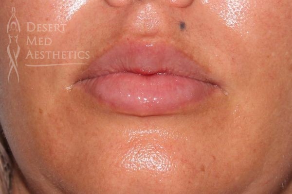 closeup of patient's fuller lips after fillers
