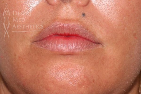 closeup of patient's lips before fillers